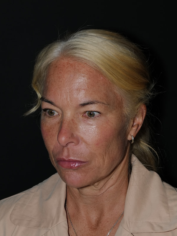 Blepharoplasty Before & After Photo