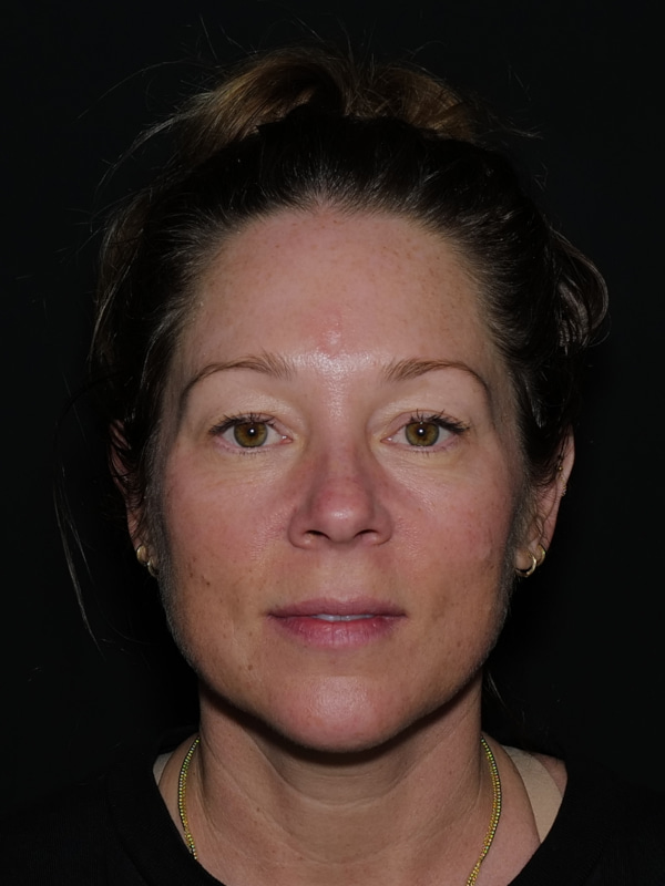 Blepharoplasty Before & After Photo