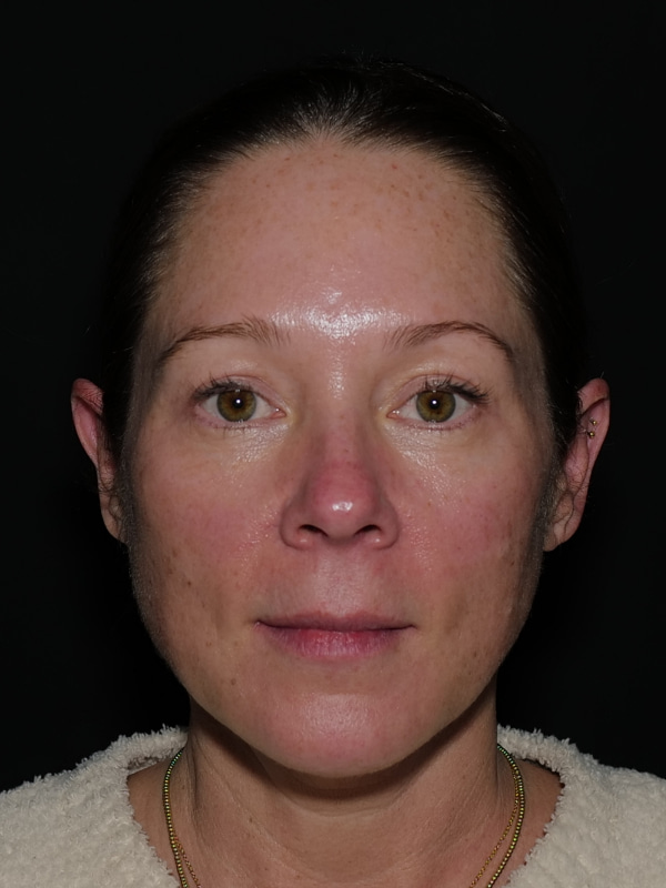 Blepharoplasty Before & After Photo