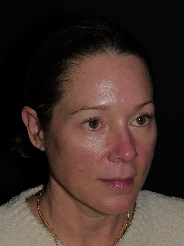 Blepharoplasty Before & After Photo