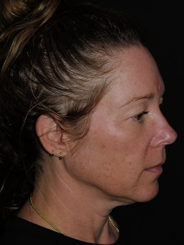 Blepharoplasty Before & After Photo