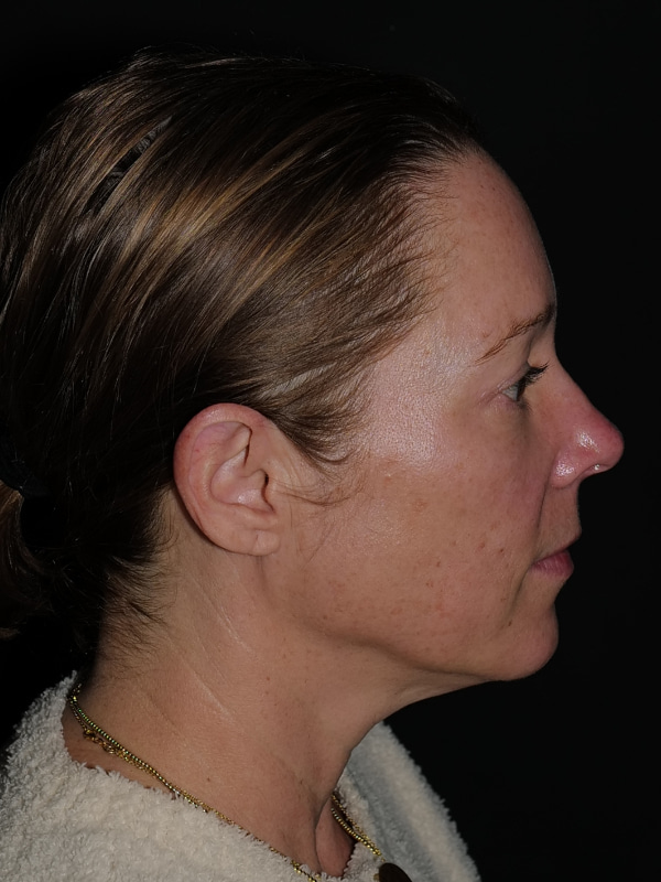 Blepharoplasty Before & After Photo