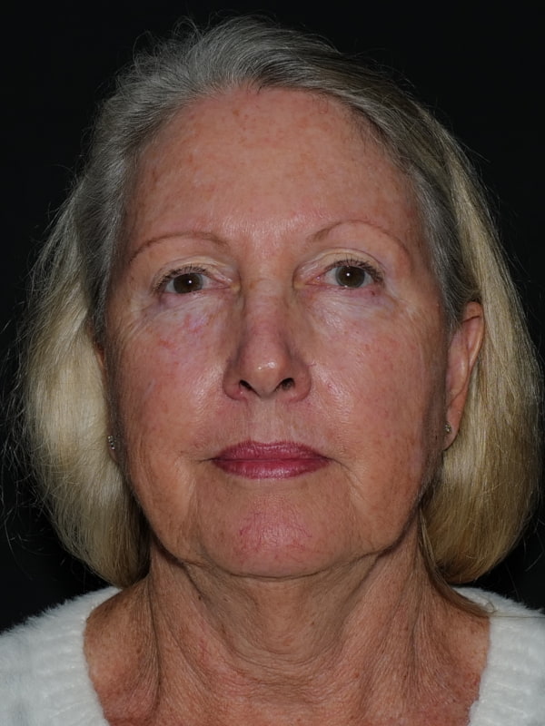Blepharoplasty Before & After Photo