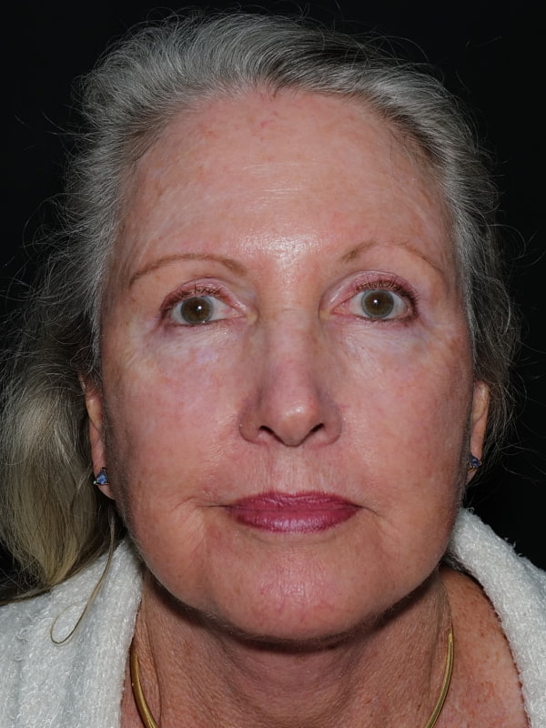 Blepharoplasty Before & After Photo