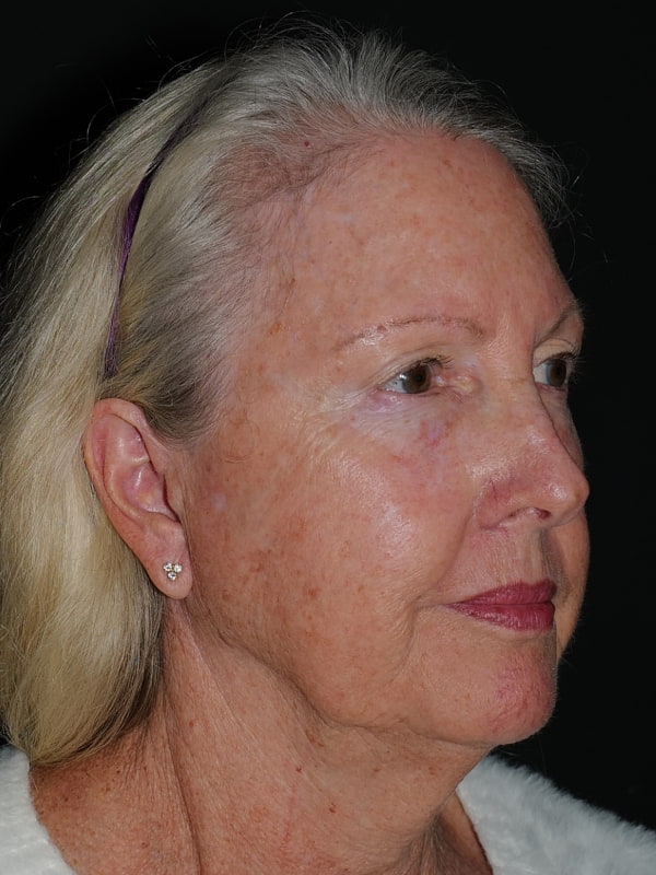 Blepharoplasty Before & After Photo