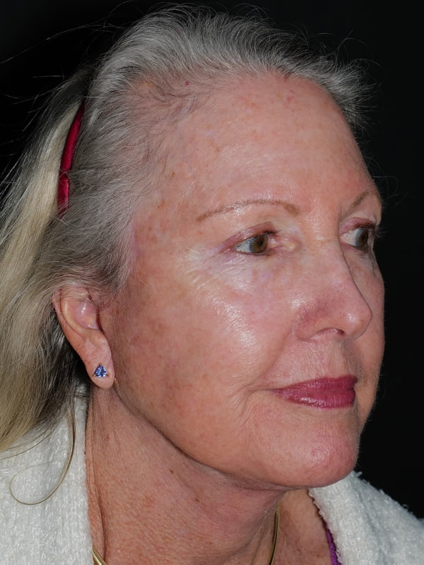 Blepharoplasty Before & After Photo