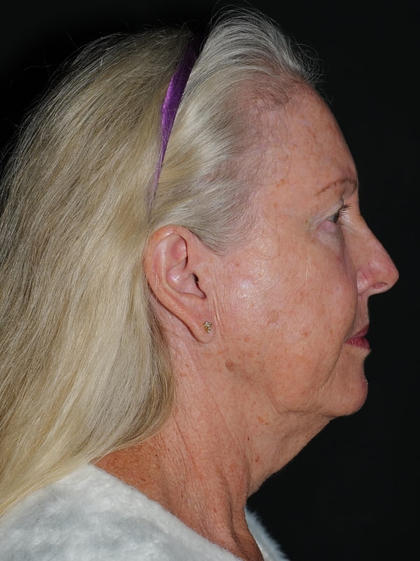 Blepharoplasty Before & After Photo