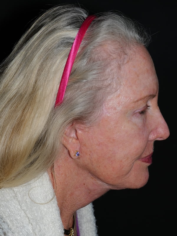 Blepharoplasty Before & After Photo