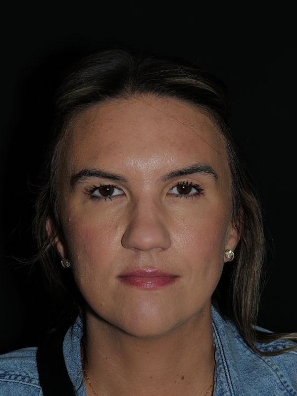 Blepharoplasty Before & After Photo