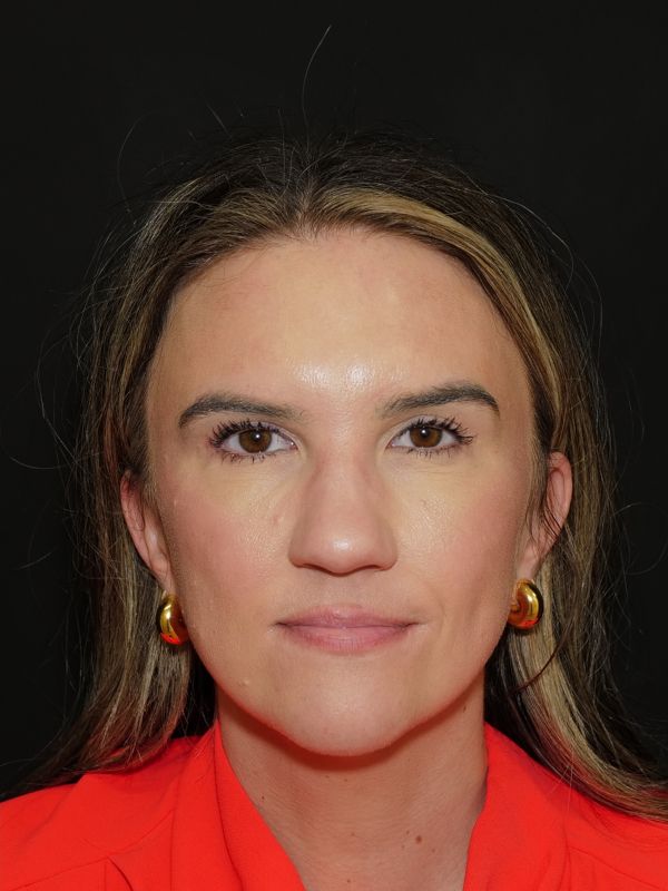 Blepharoplasty Before & After Photo