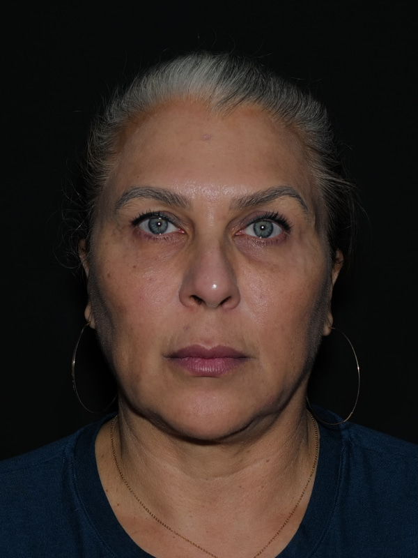 Browlift Before & After Photo