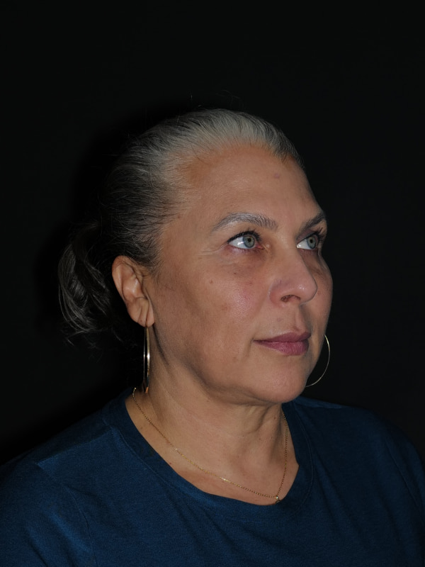 Browlift Before & After Photo