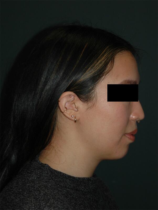 Chin Implant Before & After Photo