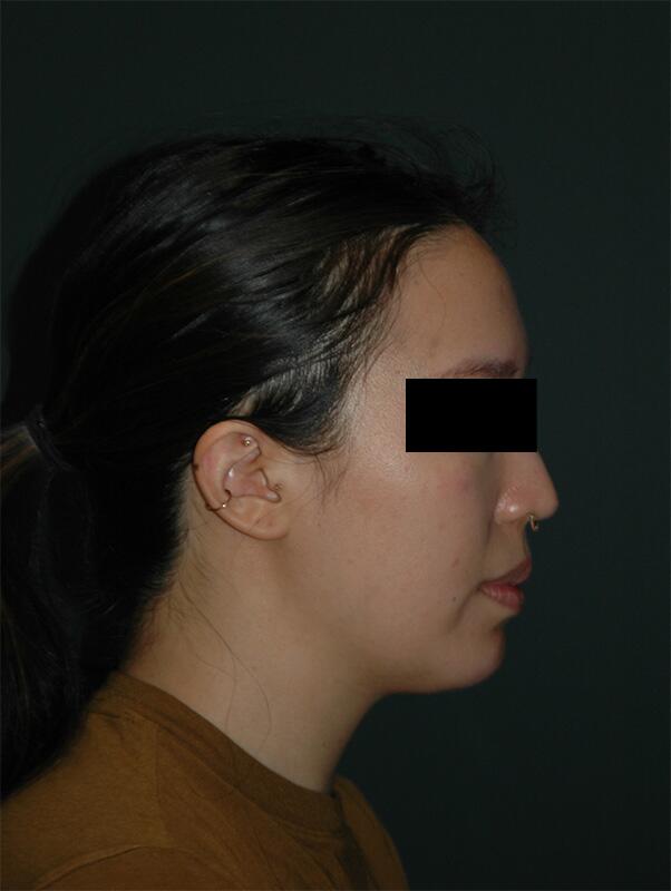 Chin Implant Before & After Photo