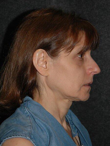 Chin Implant Before & After Photo