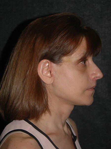 Chin Implant Before & After Photo