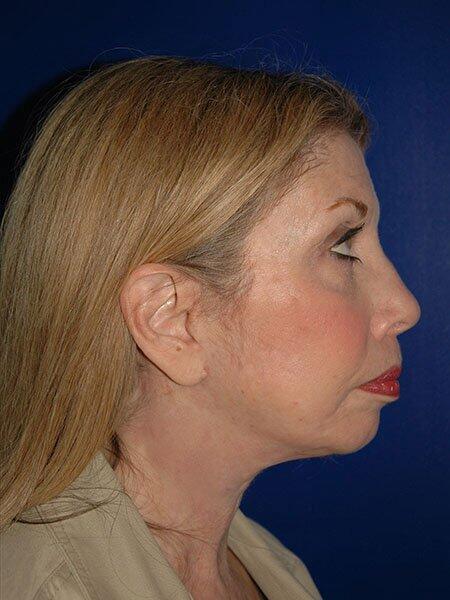 Chin Implant Before & After Photo