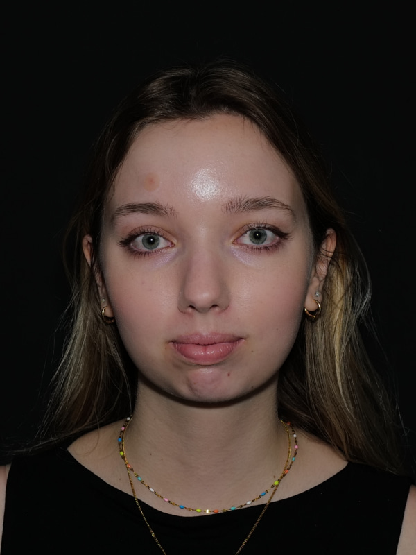 Chin Implant Before & After Photo