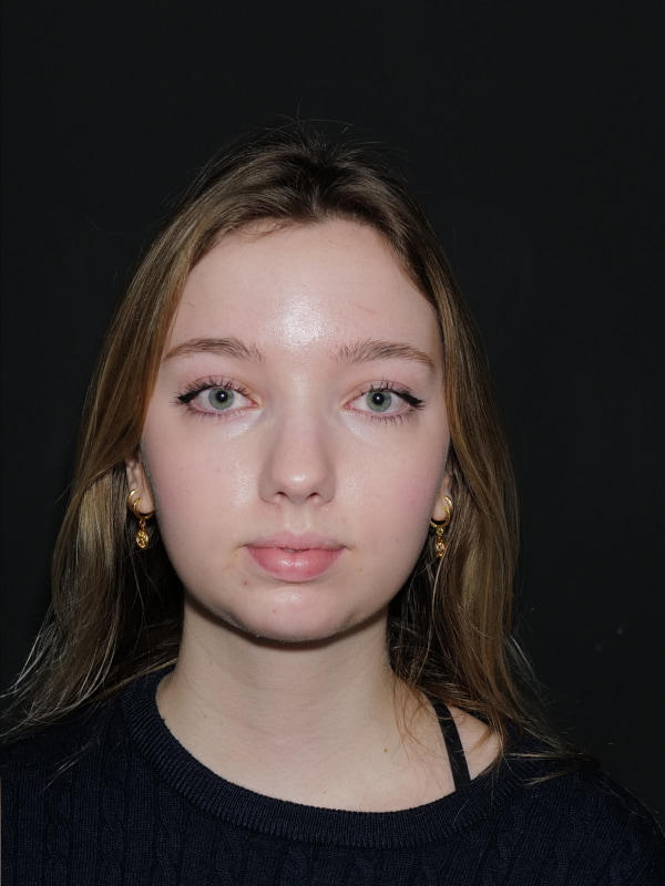 Chin Implant Before & After Photo