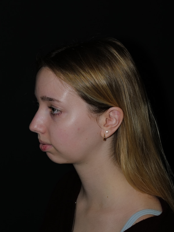Chin Implant Before & After Photo