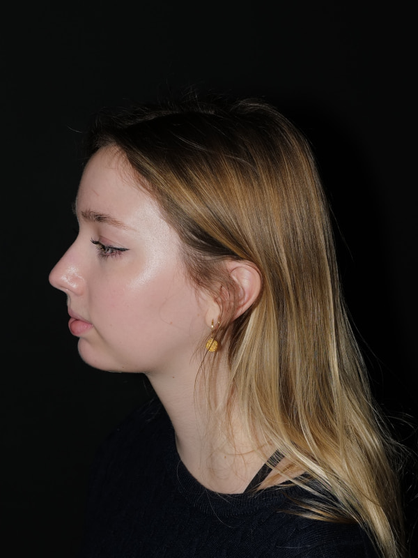 Chin Implant Before & After Photo