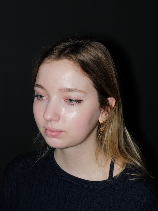 Chin Implant Before & After Photo