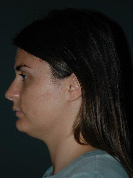 Facial Liposuction Before & After Photo
