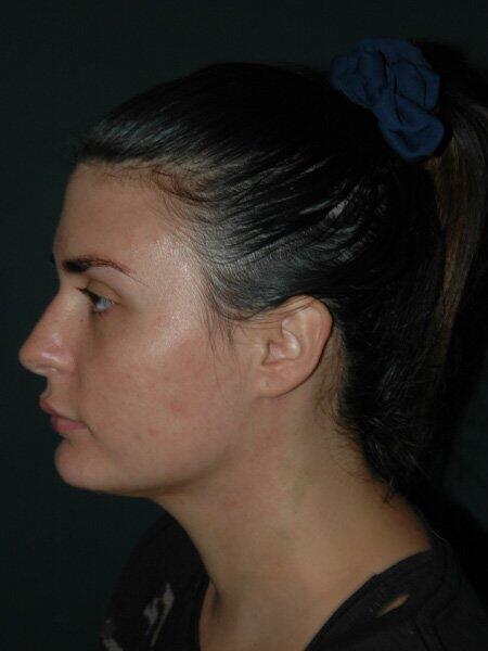 Facial Liposuction Before & After Photo