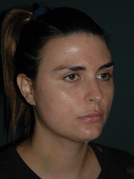 Facial Liposuction Before & After Photo