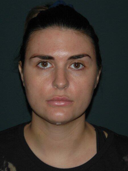 Facial Liposuction Before & After Photo