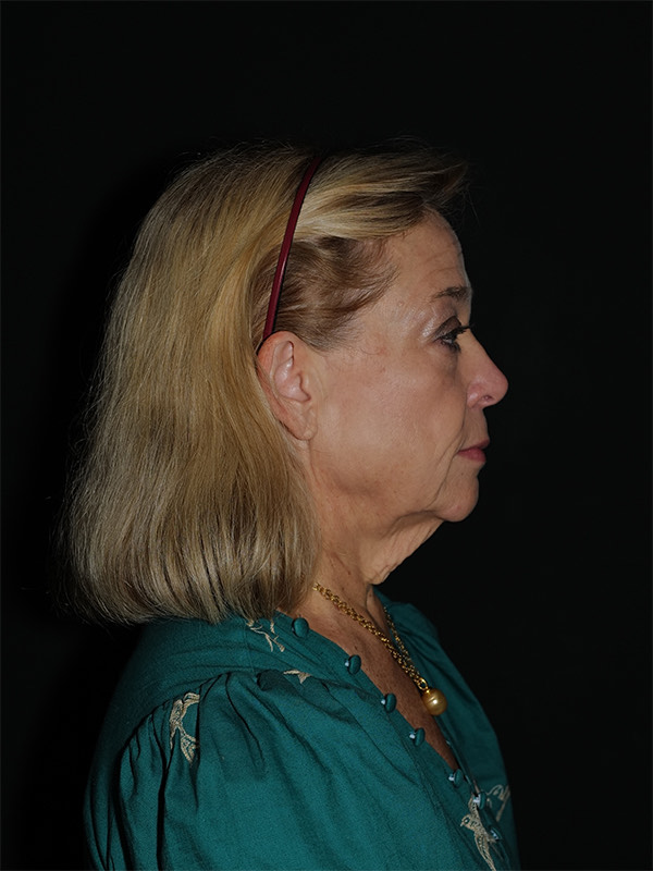Fat Transfer Before & After Photo