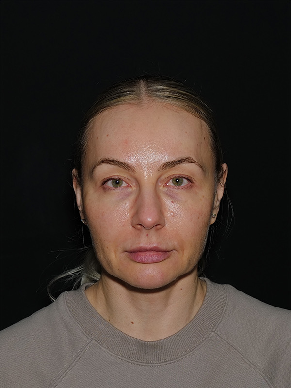 Fat Transfer Before & After Photo