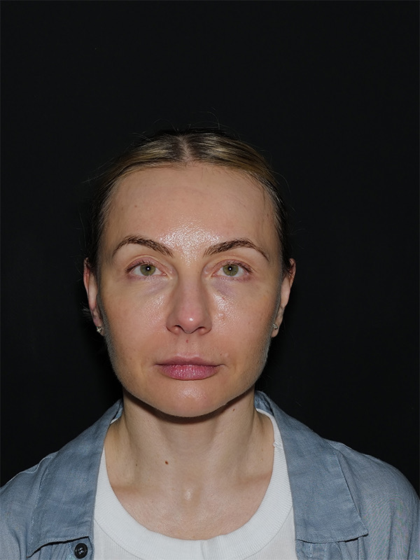 Fat Transfer Before & After Photo