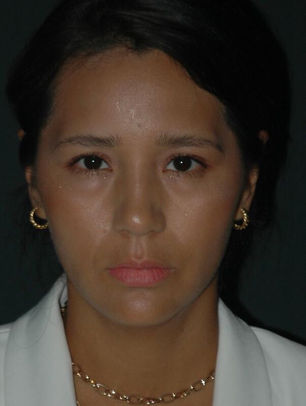 Jawline Contouring Before & After Photo