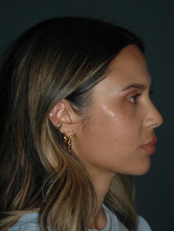 Jawline Contouring Before & After Photo