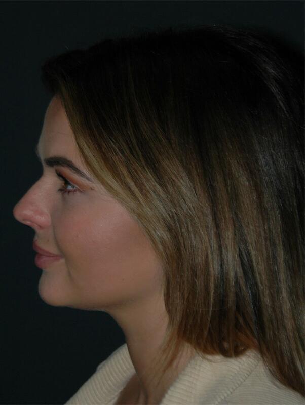 Jawline Contouring Before & After Photo
