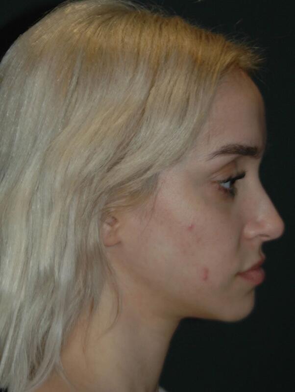 Jawline Contouring Before & After Photo