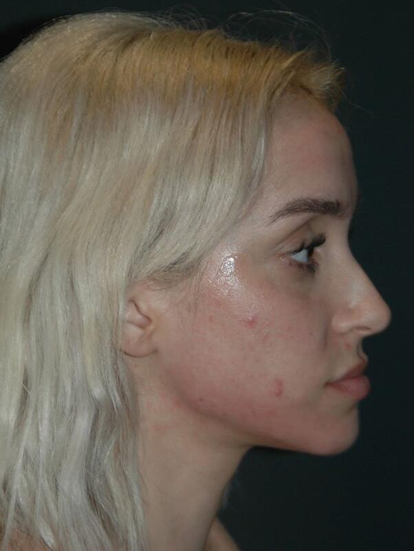 Jawline Contouring Before & After Photo