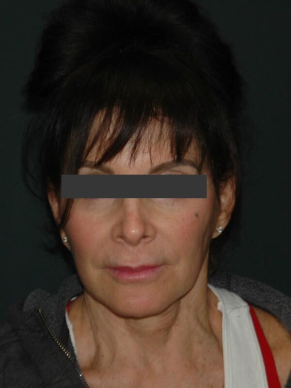 Lip Lift Before & After Photo