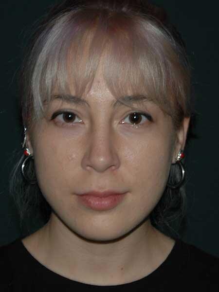 Lip Lift Before & After Photo