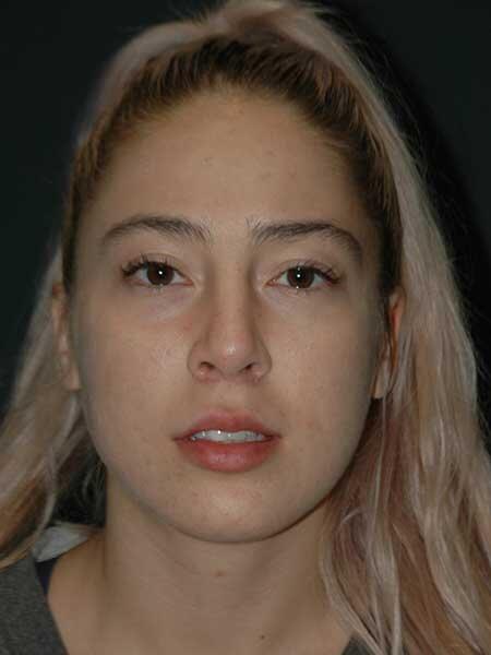 Lip Lift Before & After Photo