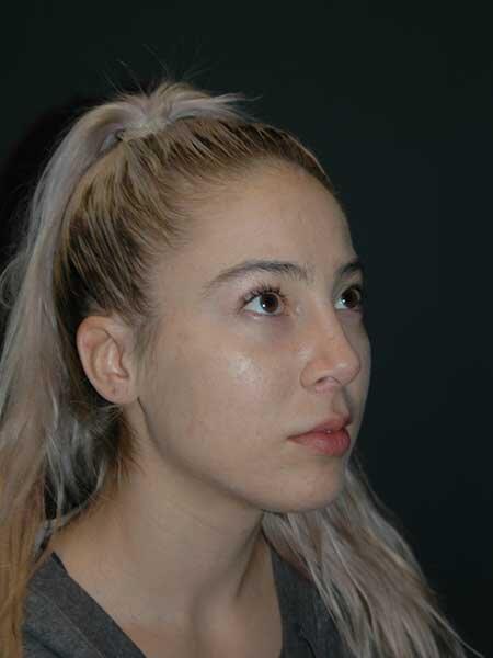 Lip Lift Before & After Photo