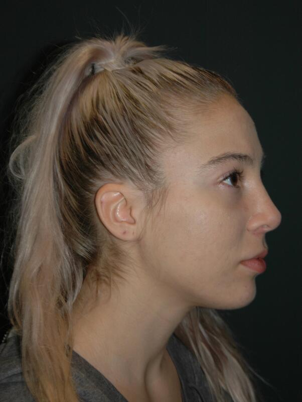 Lip Lift Before & After Photo