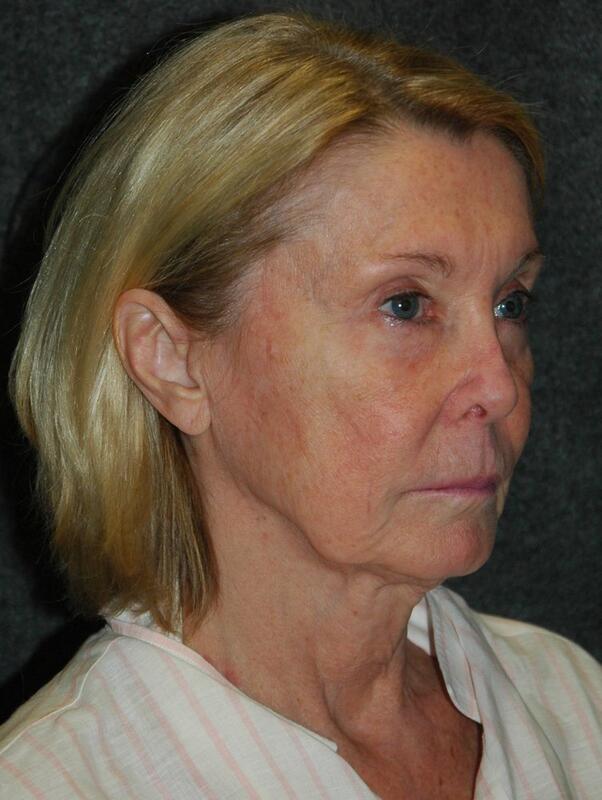 Lip Lift Before & After Photo