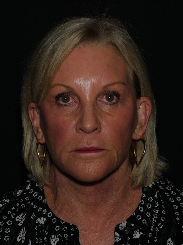 Lip Lift Before & After Photo