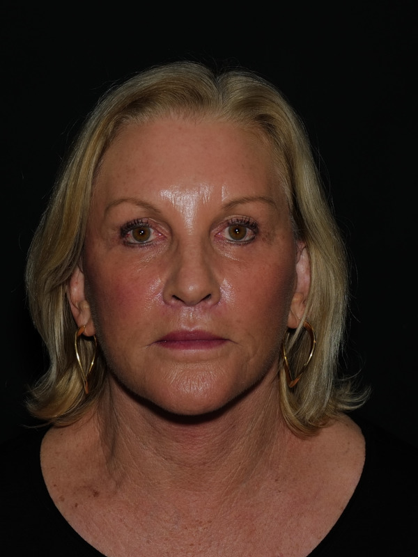 Lip Lift Before & After Photo