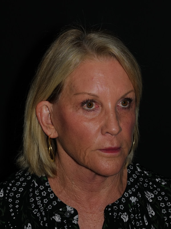 Lip Lift Before & After Photo