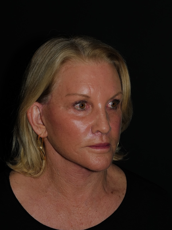 Lip Lift Before & After Photo