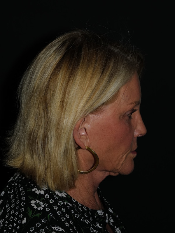 Lip Lift Before & After Photo