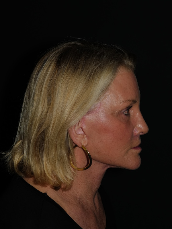 Lip Lift Before & After Photo